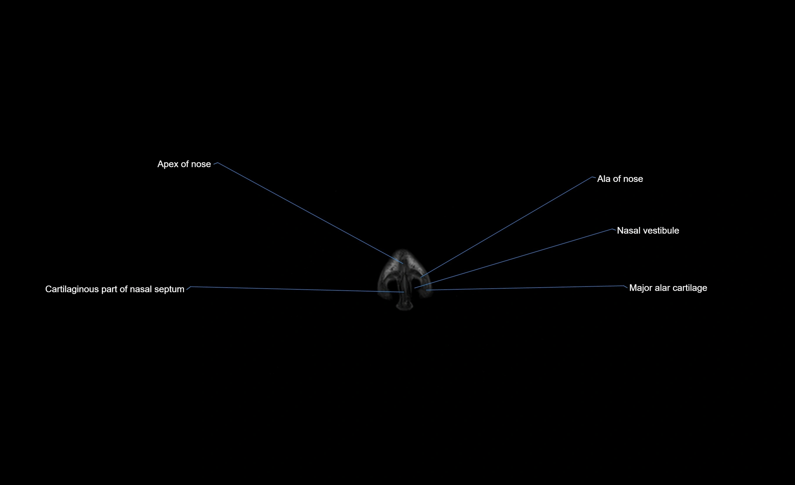 MRI face & paranasal sinuses(PNS) labelled  coronal  cross sectional anatomy 3T radiology  image-img-00001-00003.webp